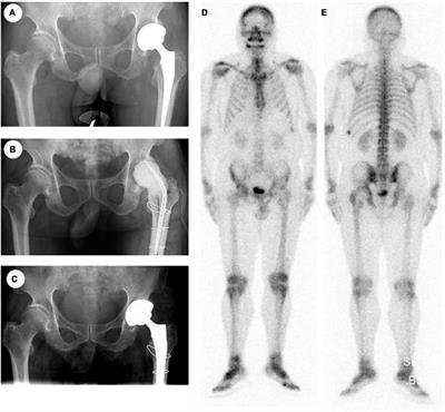 Iliopsoas fibrosis after revision of total hip arthroplasty revealed by 68Ga-FAPI PET/CT: a case report